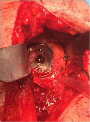 Intraoperative image of the glenoid baseplate of the reverse arthroplasty with bone graft fixed with two cannulated screws.