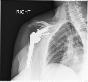 Radiograph of reverse shoulder arthroplasty with autograft coupled with two cannulated screws at 3 years after surgery.
