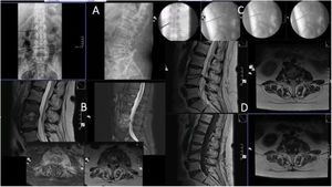 Case number 2. 58 year-old woman, L3–L4 spondylodiscitis. History of diabetes mellitus, previous colostomy bag infection with Candida. Lumbar pain symptoms with irradiation to thighs and pain with hip flexion. Six weeks since onset of symptoms. (A) Initial X-ray showing destruction of the indicated space, suggestive of spondylodiscitis. (B) MRI. Note the involvement of both iliac psoas in the axial sections. (C) Images of the percutaneous biopsy, with positive result for Candida albicans. Treatment with intravenous fluconazole and then oral. Good evolution with cure of symptoms. (D) MRI one year after the biopsy, where residual findings are observed but intervertebral fusion as a sequel, evident improvement in both projections.
