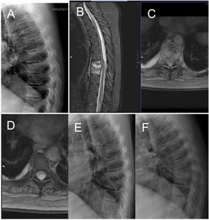 Case number 38. 50-year-old woman, spondylodiscitis D8-D9 debuting with paraplegia. Previous dorsalgia of weeks of evolution without diagnosis of spondylodiscitis. Note X-ray before the neurological symptoms with mild impingement of the D8–D9 disc space (A). With the onset of loss of strength in the lower limbs, MRI is performed, with visualisation of a large epidural abscess ascending through the spinal canal to upper segments of the dorsal spine (B–D). See X-ray with evident destruction of the disc space and cranial vertebra (E). Laminectomy and drainage of the abscess is performed, with open biopsy. Intraoperative culture showed a positive result for Streptococcus constellatus. Fortunately the patient recovered the ability to ambulate and now uses crutches but is independent. Ten months later, there is evident bony fusion of the affected segment (F).