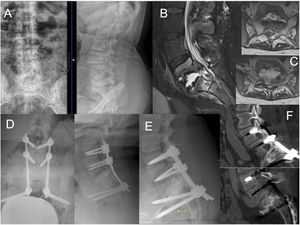 Case number 35. 37 year-old female, with a history of Down's Syndrome, obesity and pulmonary tuberculosis years ago. She presented with low back pain and weakness of the lower limbs that made it impossible for her to walk independently. X-ray (A) and MRI (B) showed extensive destruction of the L5–S1 space, with epidural abscess compressing the dural sac and the roots of the cauda equina (C). Decompression surgery and L3–S2-iliac arthrodesis was performed (D). Intraoperative culture was positive for tubercle bacillus. The patient progressed favourably with antibiotic treatment and recovered the ability to ambulate independently. A follow-up X-ray and CT scan one year after surgery showed L5–S1 fusion (E and F).
