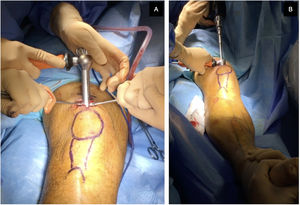 Intraoperative images of a case undergoing the SP approach. (A) Moment of placement of the trocar with protective cannula through the patellofemoral joint. (B) Position of the operated limb with the knee in 20° flexion over a sterile roller on a radiolucent table.