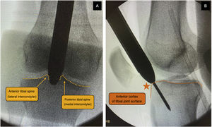Intraoperative radiological control of a patient undergoing the SP approach showing the trocar with protective cannula at the level of the patellofemoral joint and supported at the tibial entry point. (A) Medial to the lateral intercondylar tubercle (anterior tibial spine) in the coronal plane. (B) In front of the anterior articular border in the sagittal plane, following the indications of McConnell, Tornetta et al.18 This entry point was common to both types of approach.