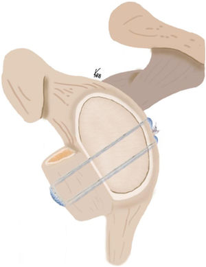 Dibujo de la técnica del bone block cerclage para reconstruir el defecto óseo en la inestabilidad anterior del hombro con el injerto óseo de cresta ilíaca fijado con cintas de alta resistencia sin metal pasadas por 2 túneles glenoideos de posterior a anterior y a través del injerto. La interconexión de las cintas en la parte posterior de la glenoides, asociada al uso de un tensor mecánico, consigue una fijación fuerte en el mismo plano del cartílago glenoideo nativo para reconstruir el defecto óseo en inestabilidad anterior del hombro.
