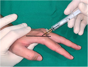 Infiltración comisural dorsal realizada en el dedo índice manteniendo la articulación metacarpofalángica ligeramente flexionada y dirigiendo la aguja hacia la cabeza del metacarpiano con un ángulo de 45° respecto al eje del metacarpiano.