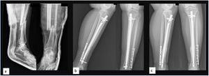 Paciente con fractura transversa de tibia distal (a) intervenido mediante clavo intramedular que tras 4 meses presentaba retardo de consolidación (b) por lo que se decidió dinamizar el sistema obtenido así la consolidación (c).