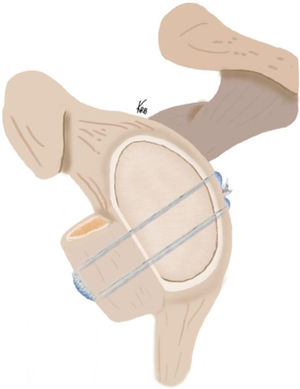 Drawing of the bone block cerclage technique for reconstructing the bone defect in anterior shoulder instability with iliac crest bone graft fixed with high strength metal-free tapes passed through 2 glenoid tunnels from posterior to anterior and through the graft. The interconnection of the tapes at the posterior glenoid, combined with the use of a mechanical tensioner, achieves a strong fixation in the same plane as the native glenoid cartilage to reconstruct the bony defect in anterior shoulder instability.