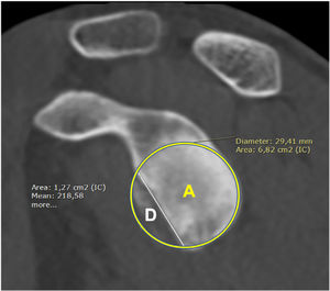 CT-2D image of a shoulder with anterior instability with bone defect. Sagittal view immediately medial to the humeral head with the best-fit circle passing through the 2 points tangential to the most posterior and inferior border of the glenoid. (A) Normal glenoid area in cm2; (D) area of the defect; and calculation in percentage of the total area of the best-fit circle using the formula D/A×100, according to Sugaya et al.1