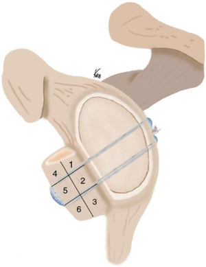 Illustrative drawing of the bone block cerclage technique to reconstruct the bone defect in anterior shoulder instability with the iliac crest graft divided by areas for measurement and analysis by CT. When osteolysis affected more than 50% of one quadrant it was considered positive for osteolysis.