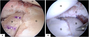 (A) Right shoulder, lateral decubitus, arthroscopic view from the anterosuperolateral portal, showing placement of the bone block on the anterior border of the glenoid at the level of the glenoid cartilage. The asterisks indicate the path of the tunnels. (B) Left shoulder, lateral decubitus, arthroscopic view from the anterosuperolateral portal, showing the stability of the bone block fixation. B: bone block; C: capsulolabral complex; G: glenoid; H: humerus; W: Wissinger rod.