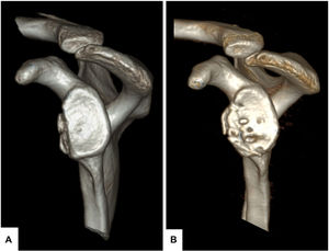 (A) En-face 3D CT image with removal of the humeral head of the case presented in Fig. 2 with a defect of approximately 20% of the glenoid area, showing 2 small bone fragments displaced medially with respect to the glenoid surface. (B) Result at 18 months after reconstruction with iliac crest allograft showing how global remodelling, which mainly affects zone 6 in the most inferior part and distal to the glenoid, results in good coverage of the defect with restoration of the glenoid area.