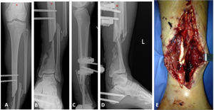 25-year-old male patient who, after a motorbike accident, was treated urgently at another centre with an external fixator and referred to our institution with the following X-rays and clinical images. (A and B) Front X-rays of the left tibia showing a fracture of the tibia and fibula, 42C3.3 without joint involvement. (C and D) Profile X-rays showing a distal diaphyseal segmental defect. (E) Clinical image of bone exposure during external tutor removal surgery.