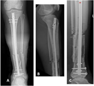 Same patient as in Fig. 1 after primary resolution of his tibial fracture using an endomedullary nail. (A) Front postoperative radiograph showing restoration of tibial length. (B and C) Profile X-rays of the leg showing correct placement of the endomedullary device and indemnity of the distal joint.