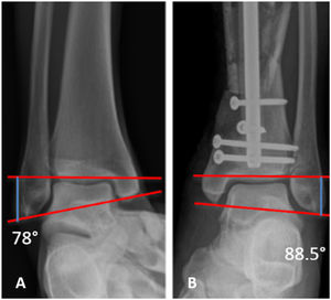 Focused radiographs of the ankle at 3 month postoperative follow-up of the same patient in Figs. 1 and 2, who presented with left distal tibioperoneal joint pain during weight bearing. (A) Radiography of the right ankle for comparison showing a talocrural angle of 75. (B) Radiograph of the ankle ipsilateral to the tibial fracture showing an increased pathological talocrural angle.