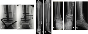 Surgical resolution of the syndesmal lesion in the same patient as in Figs. 1–3. (A) Intraoperative radioscopy of the reduction manoeuvre of the distal tibioperoneal joint. (B) Intraoperative radioscopy of fixation with two tricortical screws of the reduction achieved. (C and D) Front and profile radiographs postoperatively of the salvage surgery also showing fixation of the fibula fracture associated with fixation of the syndesmosis. (E–G) Post-operative ankle-focused radiographs of the same surgery.