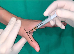 Dorsal-ulnar injection performed on the thumb at the level of the metacarpophalangeal joint keeping the thumb in maximum abduction, directing the needle towards the subcutaneous cellular tissue at the level of the head of the first metacarpal at an angle of 90 with respect to the axis of the thumb.
