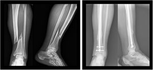 Patient treated with an intramedullary nail.