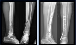 Patient treated with a locked plate.