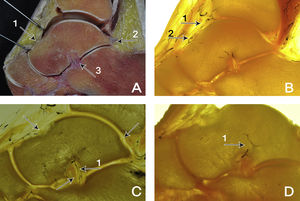 A) Corte sagital. Se observa en corte fresco la gran extensión de la superficie articular cartilaginosa del astrágalo y se muestra la inserción capsular (1), a través del cual penetran los vasos a nivel del cuello. Posteriormente se muestra el ligamento talofibular posterior (2). A nivel inferior, las inserciones del ligamento interóseo talocalcáneo (3). B) Corte sagital. Arteria tibial anterior (1). Rama de la arteria pedia dorsal (2). C) Corte sagital. Corte preparado en el que se demuestra la entrada de las arterias principales que irrigan el astrágalo: Arteria del seno del seno del tarso (1). D) Corte sagital. La arteria del seno del tarso (1) proporciona gran parte del aporte vascular intraóseo, especialmente en la porción medial y plantar del cuello.