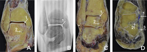 A) Corte coronal. Signos compatibles con osteonecrosis del segmento superomedial del cuerpo del talus (1). Arteria deltoidea (2). B) Corte coronal. Imagen radiológica. Se observa el signo radiológico compatible con lesión osteonecrótica del astrágalo (1). C) Corte coronal. Lesión osteocondral (1). Marcada con tinta de látex azul, se observa la rama deltoidea (2). D) Corte coronal. Arteria tibial posterior (1). Marcada con tinta de látex azul, se observa la rama deltoidea (2). Rama calcánea de la arteria tibial posterior (3).