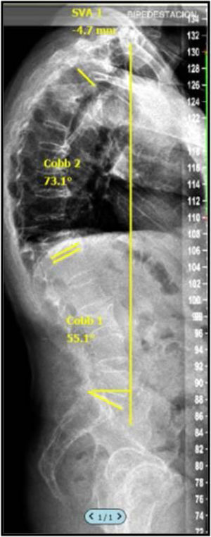 Representación en radiografía de columna completa en proyección de perfil del cálculo de SVA.
