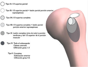 Clasificación de las lesiones del subescapular en 5 tipos según la escuela francesa y subclasificación de los subtipos I-B y II-B por rotura parcial asociada del SPE.