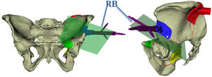Diseño de guías paciente-específicas y determinación de planos de corte. RB: rigid body que marca la posición de la pelvis en el espacio.