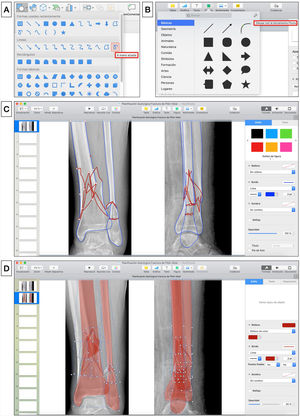 A) Herramienta para dibujar formas «a mano alzada» en Microsoft PowerPoint. B) Herramienta para dibujar con la herramienta pluma en Keynote de Apple. C) Trazado de los bordes de los principales fragmentos (azul) y líneas (rojo) de fractura. D) Simulación de reducción de los fragmentos de la fractura que se rellenan de color rojo estableciendo una opacidad del 40%.