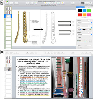 A) Dibujo de silueta de implante sobre imagen obtenida de técnica quirúrgica (placa LCP de tibia distal medial, DePuy Synthes®, Johnson & Johnson) y tornillos de cortical y de bloqueo con la herramienta pluma en Keynote de Apple. B) Esquema de pasos quirúrgicos y representación gráfica de la fractura reducida y superposición de los implantes fijados con tornillos, anotando los tipos, tamaños y longitudes según las medidas preoperatorias. AK: agujas de Kirschner; LCP: locking compression plate o placa de compresión bloqueada; MIPO: minimal invasive plate osteosynthesis.