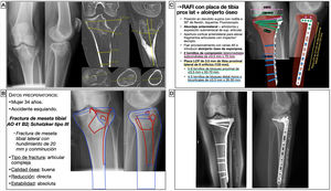 Planificación preoperatoria de fractura de meseta tibial lateral. A) Imágenes de Rx y TC con mediciones. B) Características del paciente, análisis y segmentación de la fractura y estrategia quirúrgica. C) Listado de táctica quirúrgica y representación gráfica de la planificación de reducción abierta, aporte de injerto óseo y fijación interna con tornillos de compresión y placa LCP de tibia proximal lateral. D) Resultado radiológico postoperatorio. AK: agujas de Kirschner; LCP: locking compression plate o placa de compresión bloqueada; RAFI: reducción abierta y fijación interna.