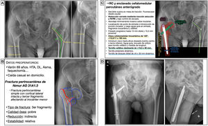 Planificación preoperatoria de una fractura pertrocantérea de fémur. A) Imágenes de Rx con las mediciones. B) Características del paciente, análisis y segmentación de la fractura y estrategia quirúrgica. C) Listado de pasos quirúrgicos y representación gráfica de planificación de reducción cerrada y enclavado cefalomedular percutáneo anterógrado con tornillo de bloqueo distal dinámico. Alternativa para la medición del ángulo cervicodiafisario izquierdo usando una plantilla de transportador de ángulos. D) Resultado radiológico postoperatorio. DL: dislipidemia; HTA: hipertensión arterial; RC: reducción cerrada; RE: rotación externa; RI: rotación interna.