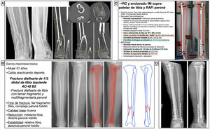 Planificación preoperatoria de fractura de diafisaria de tercio distal de tibial. A) Imágenes de Rx y TC con mediciones. B) Características del paciente y fractura, empleo de miembro contralateral a modo de plantilla para calcular la longitud y diámetro del implante y estrategia quirúrgica. C) Listado de táctica quirúrgica y representación gráfica de la planificación de reducción cerrada y enclavado endomedular de tibia suprapatelar (opcional) y reducción abierta y fijación interna con placa de neutralización de tercio de tubo y tornillos de peroné (controvertido). D) Resultado radiológico postoperatorio, en el que se observa como la fijación del peroné difiere de la planificación al haberse empleado una placa a modo de puente que aporta estabilidad relativa. AK: agujas de Kirschner; IM: intramedular; RAFI: reducción abierta y fijación interna; RC: reducción cerrada.