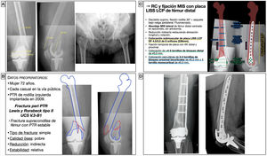 Planificación preoperatoria de fractura femoral alrededor de una PTR. A) Imágenes de Rx con mediciones. B) Características del paciente, análisis y segmentación de la fractura y estrategia quirúrgica. C) Listado de pasos quirúrgicos y representación gráfica de la planificación de reducción indirecta y fijación interna con placa LISS-LCP de fémur distal y tornillos de bloqueo percutáneos. D) Resultado radiológico postoperatorio tras reducción y fijación con placa condilar de compresión de ángulo variable y tornillos de bloqueo. AK: agujas de Kirschner; DF: distal femur o fémur distal; LCP: locking compression plate o placa de compresión bloqueada; LISS: less invasive stabilization system o sistema de estabilización poco invasivo; MIS: minimal invasive surgery o cirugía mínimamente invasiva; PTR: prótesis total de rodilla; RC: reducción cerrada.