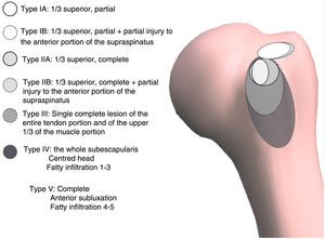Classification of subescapularis lesions into 5 types according to the French school and subclassification of the subtypes I-B and II-B by SE associated partial rupture.