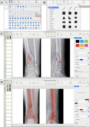 (A) Tool for drawing shapes “Freeform” in Microsoft PowerPoint. (B) Tool for drawing with the pen tool in Apple Keynote. (C) Tracing the edges of the main fragments (blue) and fracture lines (red). (D) Simulation of reduction of the fracture fragments that are filled with red by setting an opacity of 40%.