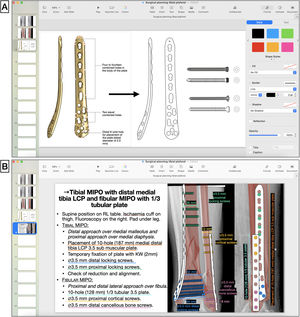 (A) Drawing of implant silhouette on surgical technique image obtained (medial distal tibial LCP plate, DePuy Synthes®, Johnson & Johnson) and cortical and locking screws with the pen tool in Apple Keynote. (B) Diagram of surgical steps and graphic representation of the reduced fracture and overlapping of the implants fixed with screws, noting the types, sizes, and lengths according to preoperative measurements. KW: K-wires; LCP: locking compression plate; MIPO: minimal invasive plate osteosynthesis.