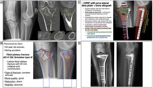 Preoperative planning of lateral tibial plateau fracture. (A) X-ray and CT images with measurements. (B) Patient characteristics, analysis and segmentation of the fracture and surgical strategy. (C) Surgical tactic list and graphic representation of the planning of open reduction, bone grafting and internal fixation with compression screws and lateral proximal tibial LCP. (D) Postoperative radiological findings. KW: Kirschner wires; LCP: locking compression plate; ORIF: Open reduction and internal fixation.