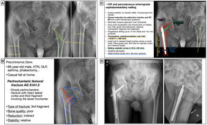 Preoperative planning of a pertrochanteric femoral fracture. (A) X-ray images with measurements. (B) Patient characteristics, analysis and segmentation of the fracture and surgical strategy. (C) List of surgical steps and graphic representation of planning of closed reduction and percutaneous anterograde cephalomedullary nailing with dynamic distal locking screw. Alternative for measurement of the left cervico-diaphyseal angle using an angle protractor template. (D) Postoperative radiological findings. CR: closed reduction; DL: dyslipidaemia; ER: external rotation; HT: hypertension; IR: internal rotation.