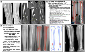 Preoperative planning of distal tibial diaphyseal fracture. (A) X-ray and CT images with measurements. (B) Patient and fracture characteristics, use of contralateral limb as a template to calculate implant length and diameter, and surgical strategy. (C) Surgical tactic list and graphic representation of the planning of closed reduction and endomedullary nailing of suprapatellar tibia (optional) and open reduction and internal fixation internal fixation with one-third tubular neutralisation plate and fibular screws (controversial). (D) Postoperative radiological findings, showing how the fixation of the fibula differs from the planning as a plate was used as a bridge to provide relative stability. CR: closed reduction; IM: intramedullary; KW: Kirschner wire; ORIF: open reduction and internal fixation.