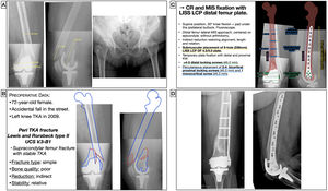 Preoperative planning of femoral fracture around a TKR. (A) X-ray images with measurements. (B) Patient characteristics, analysis and segmentation of the fracture and surgical strategy. (C) List of surgical steps and graphic representation of the planning of indirect reduction and internal fixation with LISS-LCP distal femoral plate and percutaneous locking screws. (D) Postoperative radiological result after reduction and fixation with variable angle compression condylar plate and locking screws. CR: closed reduction; DF: distal femur; KW: Kirschner wires; LCP: locking compression plate; LISS: less invasive stabilisation system; MIS: minimal invasive surgery; TKA, Total Knee Arthroplasty.