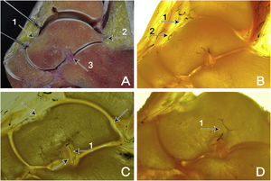 (A) Sagittal section. The large extension of the cartilaginous articular surface of the talus is seen in fresh section and the capsular insertion is shown (1), through which the vessels penetrate at the level of the neck. Posteriorly, the posterior talofibular ligament is shown (2). Below, the insertions of the interosseous talocalcaneal ligament (3). (B) Sagittal section. Anterior tibial artery (1). Branch of the dorsal pedal artery (2). (C) Sagittal section. Prepared section showing the entry of the main arteries supplying the talus: tarsal sinus artery (1). (D) Sagittal section. The tarsal sinus artery (1) provides much of the intraosseous vascular supply, especially in the medial and plantar portion of the neck.