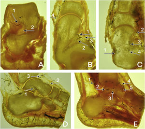 (A) Coronal section. Tarsal sinus artery (1) and talocalcaneal interosseous ligament (2). (B) Cross section. Dorsal pedal artery (1), lateral tarsal artery (2), branches of the anterior tibial artery (3). (C) Cross section. Posterior tibial artery (1). On the other side, the anterior tibial artery (2) dividing into the dorsal pedal artery (3) and the lateral tarsal artery (4). (D) Sagittal section. Tarsal sinus artery (1). Above the neck of the talus, the dorsal pedal artery (2) is seen coming from the anterior tibial artery (3). (E) Sagittal section. On the left side, the peroneal artery (1) and the perforating branch of the peroneal artery (2) with the formation of the intraosseous anastomoses (3) can be seen. At the upper end of the neck, the anterior tibial artery (4) and the dorsal branch of the dorsal pedal artery (5).