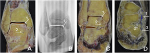 (A) Coronal section. Signs compatible with osteonecrosis of the superomedial segment of the talus body (1). Deltoid artery (2). (B) Coronal section. Radiological image. Radiological sign compatible with osteonecrotic lesion of the talus (1). (C) Coronal section. Osteochondral lesion (1). Marked with blue latex ink, the deltoid branch can be seen (2). (D) Coronal section. Posterior tibial artery (1). Marked with blue latex ink, the deltoid branch is observed (2). Calcaneal branch of the posterior tibial artery (3).