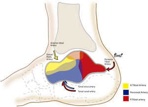 Sagittal view. The graphic representation of the vascular supply of the talus is shown in 3 colours. Yellow: the anterior tibial artery encompassing most of the head and neck in the dorsal segment via the dorsal pedal artery and a smaller portion via the perforating branch of the peroneal artery to the body. Blue: the contribution of the peroneal artery is shown, but the major contribution of the peroneal artery will be through the perforating peroneal branch together with the lateral tarsal branch of the anterior tibial artery to form the large tarsal sinus network, which constitutes the most important intraosseous network of the talus represented with a purple intermediate colour. Red: the posterior tibial artery is the second most important, comprising the entire intraosseous network that irrigates the posterior third of the talus through the deltoid and calcaneal branch, and also contributes to form the tarsal sinus plexus, represented in purple.