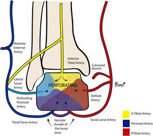 Coronal view. Graphic representation of the talus blood supply in 3 colours. Yellow: the anterior tibial artery penetrates through the cartilage-deprived area at the neck of the talus with the dorsal pedal branch of the anterior tibial artery. Blue: the major proportion of the intraosseous supply to the talus comes through the tarsal sinus vascular arcade marked in purple. Red: Posterior tibial artery represented in the deltoid, calcaneal and tarsal canal branches.