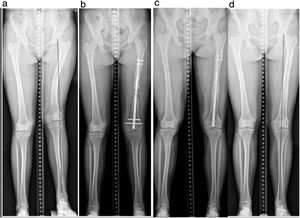Shortening of 5.5cm, valgus and rotational deformity of the left femur after neonatal septic arthritis of the knee. Twelve-year-old female. (a) Preoperative teleradiographs. (b) Lengthening and angular/rotational correction using Precice2® retrograde nail. (c) Consolidation and compensation of the discrepancy 6 months postoperatively. The knee locking screws required early removal due to loosening of one of them. (d) Radiological control 12 months after nail removal.