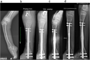 Eight-year-old patient with fibula agenesis, knee dislocation and missing ankle. (a) Preoperative. (b) Immediate postoperative period after correction of deformities, ankle fixation and knee stabilisation. Given the considerable risk of reluxation, it was decided to keep the nail “dormant” (without distraction) and allow the osteotomy to consolidate. (c) Consolidated osteotomy 12 months postoperatively. (d) New osteotomy at that time to begin elongation and removal of the femoral 8-plate. (e) 120 days postoperatively, having achieved the objective of 4cm lengthening. (f) 8 months postoperatively with the segment consolidated.