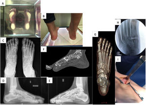 Bilateral partial bony coalition at the level of the joint between the base of the first metatarsal and the first wedge. (A) Plantar footprint on podoscope. (B) Clinical image of the hindfoot. (C) Dorsal-plantar loading X-ray prior to surgery showing the bilateral coalition. (D) Profile projection radiograph of the Left foot under load. (E) X-ray of the loaded profile projection of the right foot. (F) CT image (sagittal section). (G) Three-dimensional reconstruction CT image. (H) Fluoroscopy image after resection of the coalition during surgery. (I) Image of the resection area during surgery.
