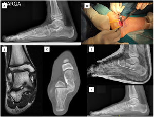 Calcaneal-astragaline coalition with less than 50% extension. (A) Pre-surgical foot loading profile radiograph. (B) MR image (coronal slice). (C) CT image (coronal section). (D) Image of the resection site during surgery. (E) Postoperative X-ray after resection and calcaneal lengthening osteotomy fixed with K-wire. (F) Loading X-ray in profile projection after consolidation of the osteotomy.