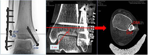Mediciones en proyección radiológica de mortaja y en estudio TAC. DSA: distancia sindesmosis anterior; DSP: distancia sindesmosis posterior; ECM: espacio claro medial; ECTF: espacio claro tibiofibular; Flecha: nivel de corte axial a 1cm de la línea articular; STF: solapamiento tibiofibular.